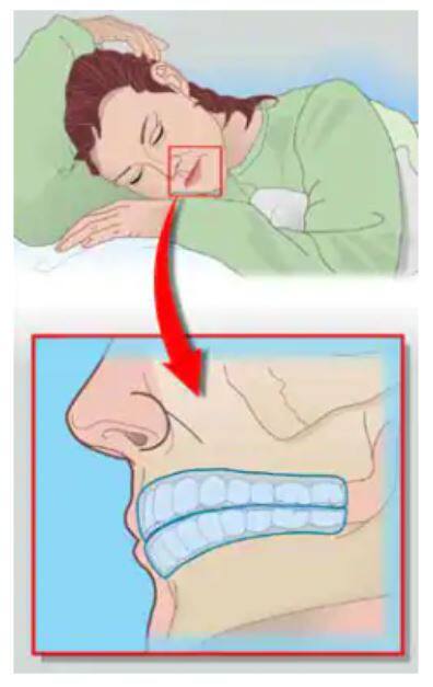 Chránič, který nosíte během spánku, ochrání vaše zuby, ale není to lék.